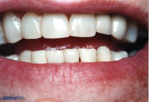 Broken Teeth Composite After
