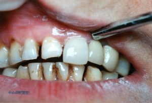 Broken Teeth Composite Before