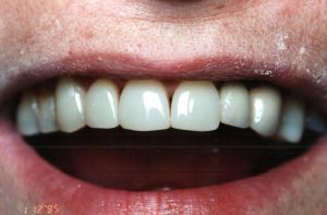 Broken Teeth Porcelain After