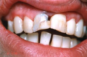 Broken Teeth Porcelain Before