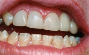 Chipped And Worn Teeth After