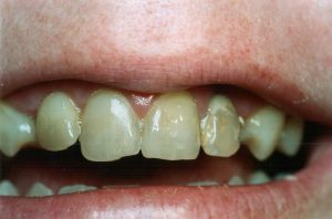 Chipped And Worn Teeth Before