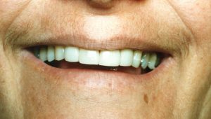 Composite Tooth Coloured Filling After