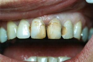 Composite Tooth Coloured Filling Before