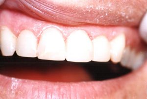 Porcelain Crowns 2 After