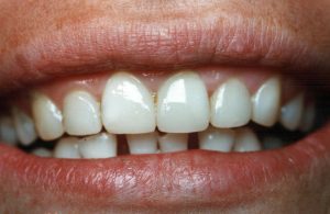 Porcelain Crowns After