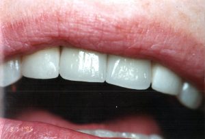 Teeth Whitning After