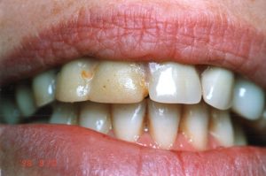 Teeth Whitning Before