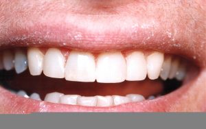 Veneers After