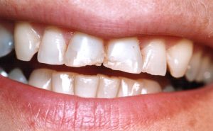 Veneers Before