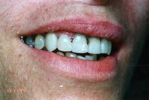 discoloured Teeth After