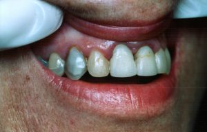 discoloured Teeth Before